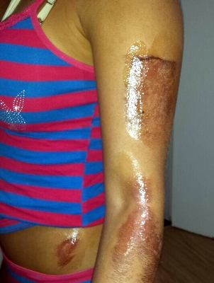 Com a queda, a jovem ficou com vários ferimentos pelo corpo, além de ter quebrado o braço (Foto: Thais Gonzales/Acervo pessoal)